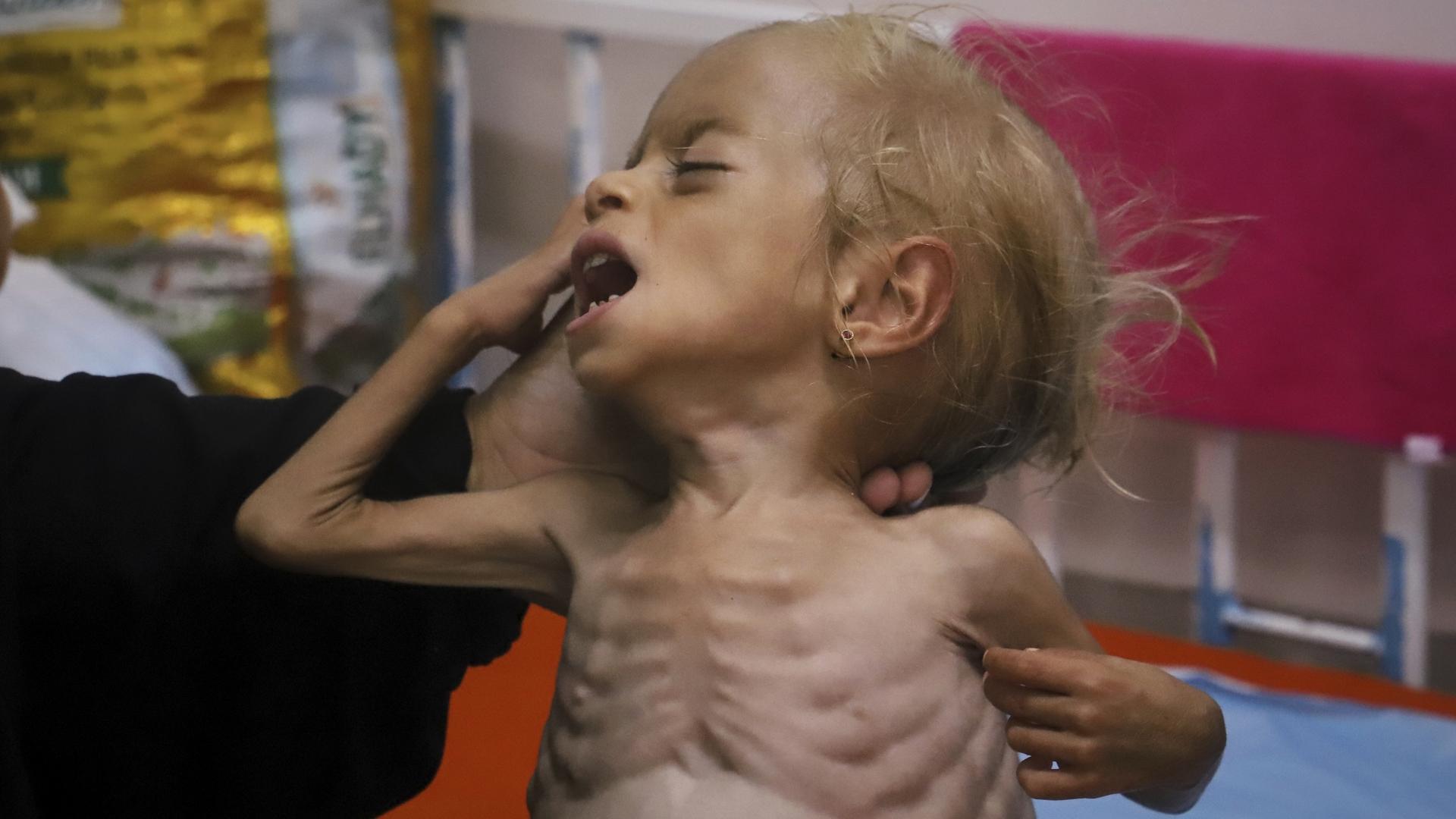 Malnourished children arrive daily at a Gaza hospital as Netanyahu denies hunger