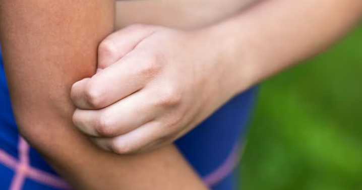 The £15 solution for anyone prone to midge and mosquito bites