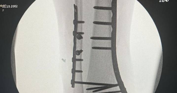 Student 'may never walk normally again' after 'faulty Lime bike' leaves leg broken in 3 places