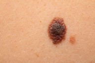 Cancer Vaccine Misses Mark in Phase 3 Advanced Melanoma Trial