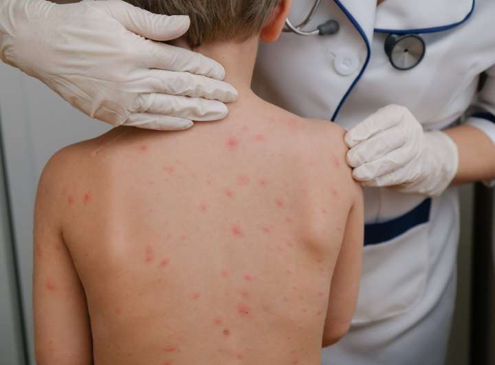 Alarma sanitaria en Paraguay: Autoridades han registrado más de 20 casos de sarampión