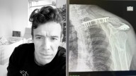 ¡Tremenda ‘chamba’! Rigoberto Urán muestra la cicatriz que le dejó su insólito accidente con la bicicleta de su hija