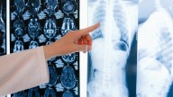 Descubren nueva vía para potenciar la inmunoterapia contra el cáncer de pulmón más agresivo