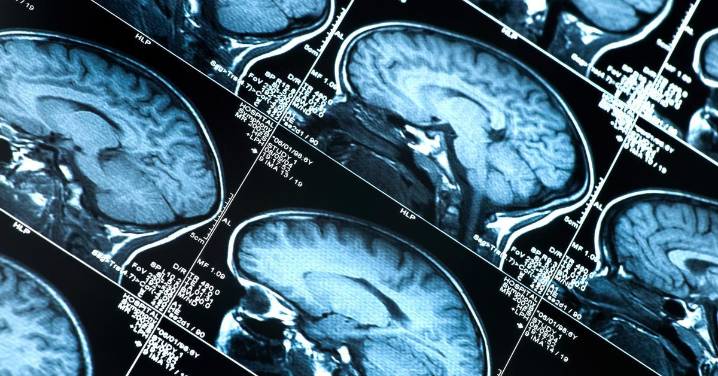 ¿Qué papel juega el colesterol en el Alzheimer hereditario?