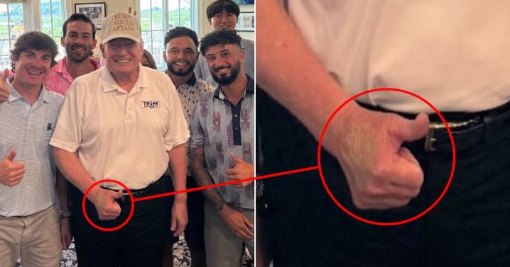 Trump, 79, Soothes Bruised Hand With Surprise Golf Outing