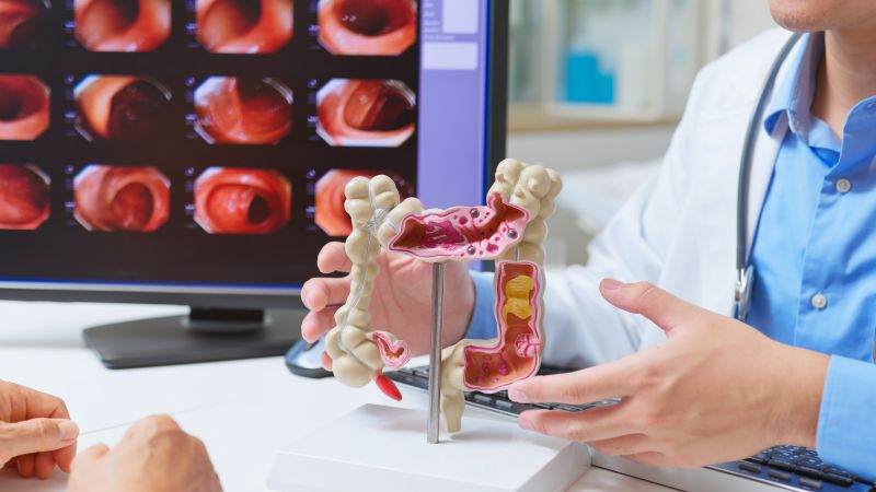 As more young people get screened, more colon cancer is being found early. Here’s how to lower your risk