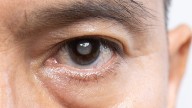 Vitamin D Deficiency Tied to Cataract Risk in Young Adults