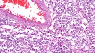 CNS Prophylaxis in DLBCL: What Clinicians Should Know