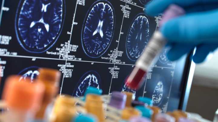 Científicos españoles descubren una alteración en la captación del colesterol en los pacientes con alzhéimer