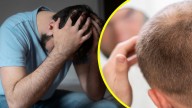 ISP advierte sobre fármaco para la calvicie: Podría causar depresión e ideación suicida