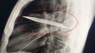 Man complains of sore nipple only for docs to find giant KNIFE had been lodged in his chest for eight years