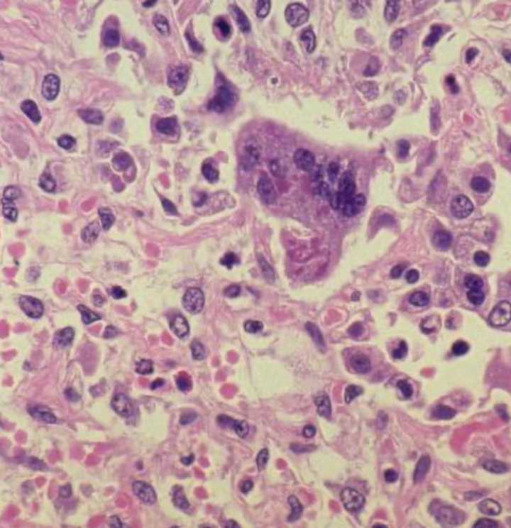 Wisconsin reports its first measles cases of 2025
