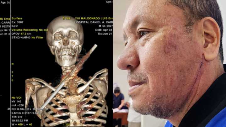 Salvan la vida de paciente que tenía un fierro incrustado en el cuello