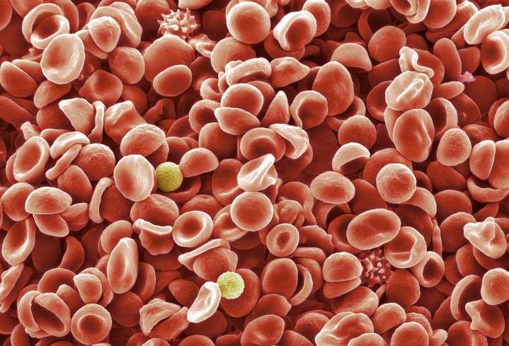 Poor MDS Outcomes Linked to Divergence from Treatment Guidelines