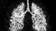 This lung disease can be dangerous for younger people, too