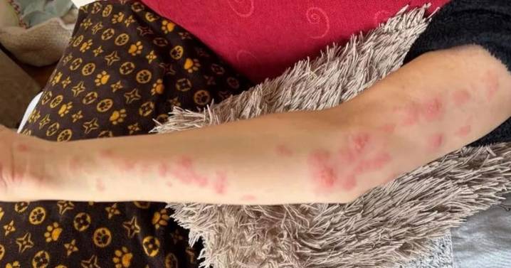 Woman covered in agonising burns after wholesome day picking blackberries