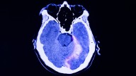 Diabetes Tied to Slower Brain Recovery After TBI