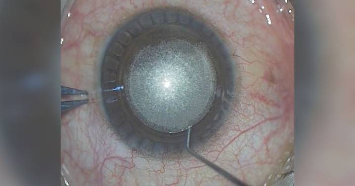 Ridge sign helps identify anterior, posterior planes in SMILE