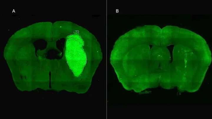 Especialistas del CONICET lograron frenar un tipo de cáncer cerebral con una novedosa estrategia terapéutica