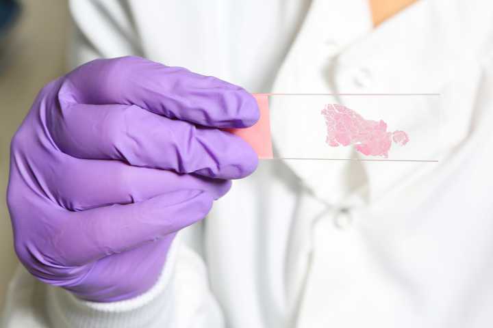 Biomarker Discovery Could Improve Personalized Care in ER+ Breast Cancer
