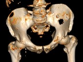 Metastatic Bone Cancer Immune Suppression Linked to Neutrophils, DKK1