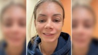 Acaba en urgencias por reventarse un grano en el 'triángulo de la muerte'