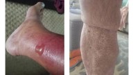 How to protect yourself from Vibrio vulnificus, the bacteria found in some coastal waters