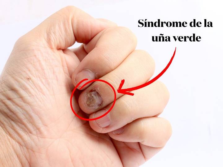 Síndrome de la uña verde en manos o pies