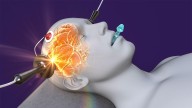 Electroconvulsive Therapy Patients Often Not Fully Informed of Risks, Study Suggests