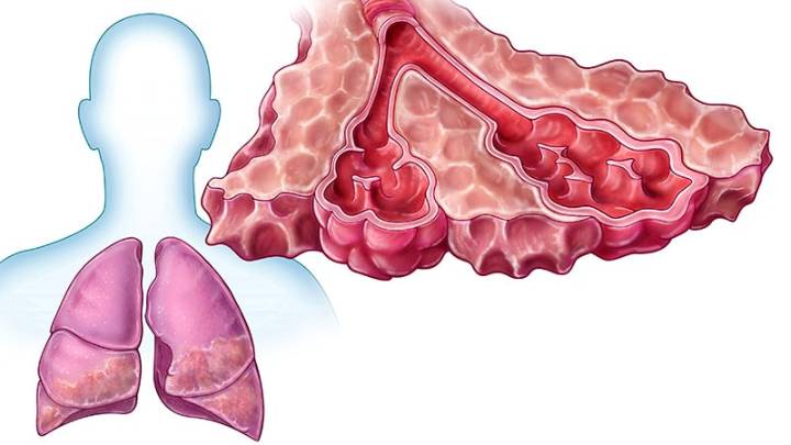 RA May Be a Causal Driver of Idiopathic Pulmonary Fibrosis