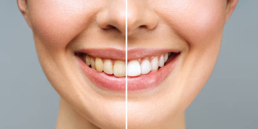 Este es el mejor remedio casero para blanquear tus dientes y lucir una mejor sonrisa