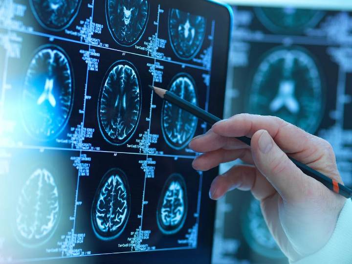 Tiny Traces of Lithium May Help Protect the Brain From Alzheimer’s