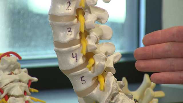 Woman's Doctor: How to help this painful, common spine condition