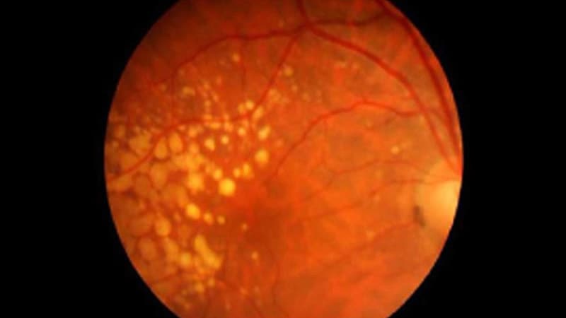 Long-Term Use of Metformin May Prevent AMD in Diabetes