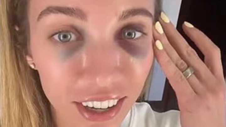 Caitlin Clark's Indiana Fever teammate shows off gruesome facial injuries after collision with rival in game