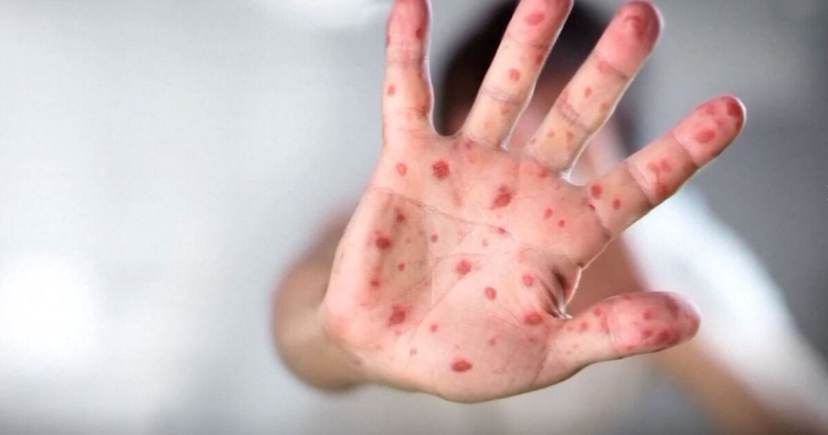Nine measles cases confirmed in Northeast Wisconsin