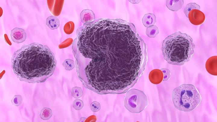 Other Lymphomas May Be Linked to Post-Mastectomy Breast Implants