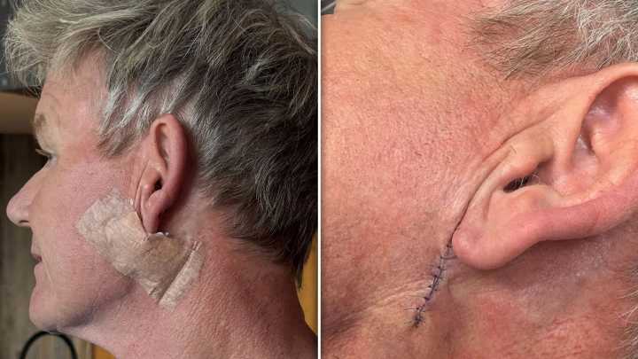 Gordon Ramsay Gets Treatment to Remove Skin Cancer, Shows Surgery Scar