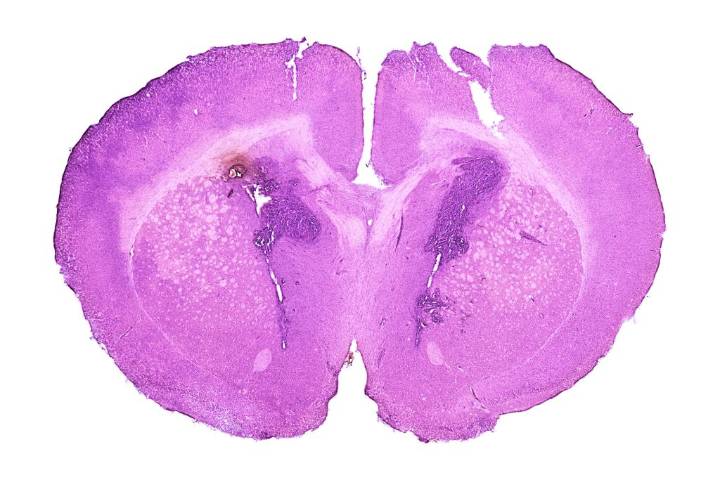 Glioma Treatment May Benefit from Acoustic Biomarker