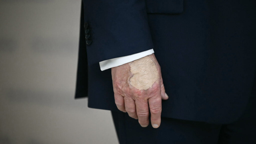 What Trump's hand bruise signifies, explained by vascular surgeons