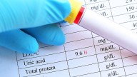 Urate Drops Modestly in Semaglutide Users With Diabetes