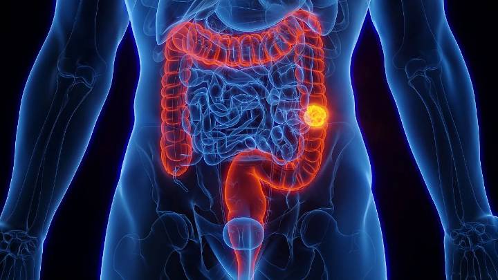 Local Colorectal Cancer Incidence on the Rise in Adults Aged 45 to 49 Years