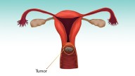 Higher Cervical Cancer Deaths Seen Where Screening Is Low