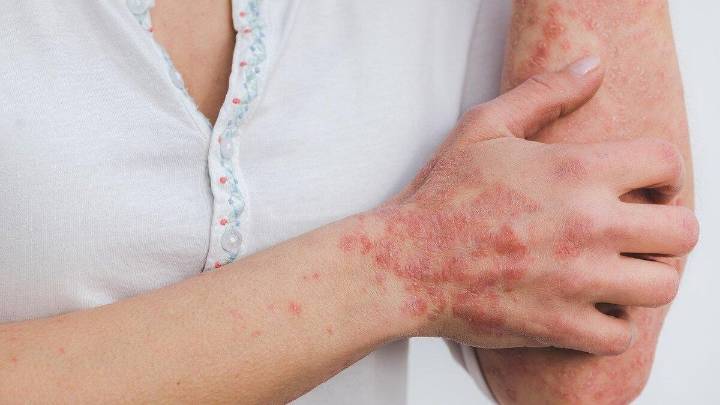 ¿Sarpullido con este calor? Descubre qué es la miliaria y cómo evitarla rápidamente