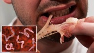 Doctors warn after a man suffers brain parasites from eating undercooked bacon