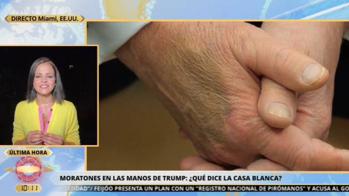 La razón de la Casa Blanca para justificar el maquillaje en las manos de Trump