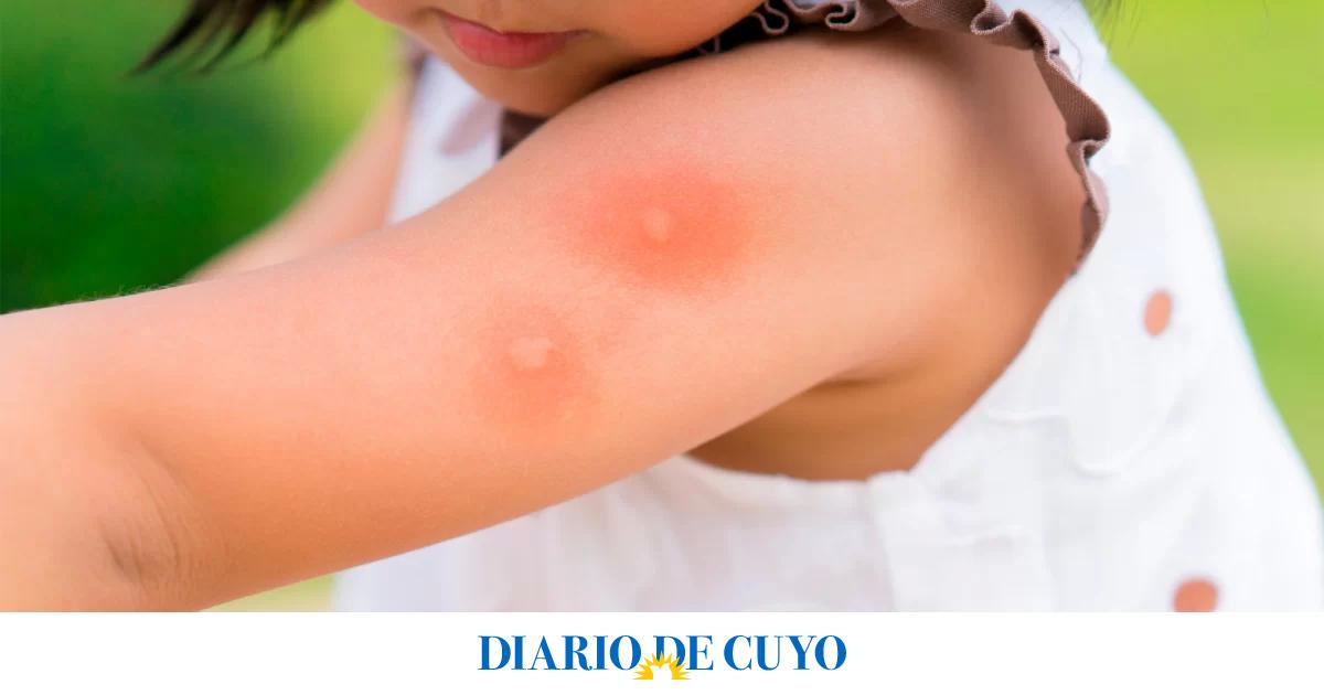 Día Internacional de la Lucha contra el Dengue: infografía para entender el riesgo y cuáles son los signos de alarma