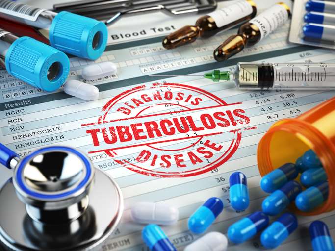 CRISPR-Based Tuberculosis Saliva Test Created