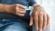 Artritis psoriásica de inicio tardío: más comorbilidades y subtratamiento