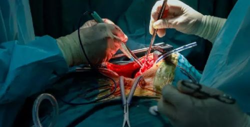 Primer transplante de pulmón de cerdo en cuerpo humano